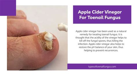 PPT - Apple Cider Vinegar For Toenail Fungus PowerPoint Presentation ...