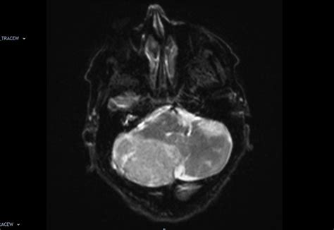 MRI Dysplastic cerebellar gangliocytoma (Lhermitte-Duclos disease)