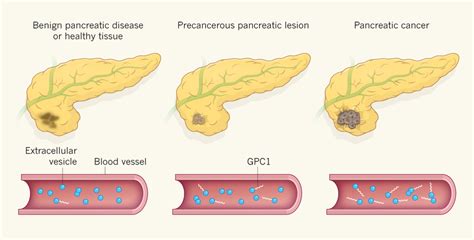 Possible Diagnostic Marker for Pancreatic Cancer - National Cancer Institute