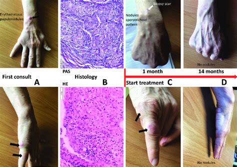 (A) first clinical examination. (B) Periodic acid-Schiff (PAS) stain ...