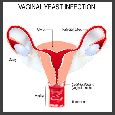 Candida Vaginal Infection