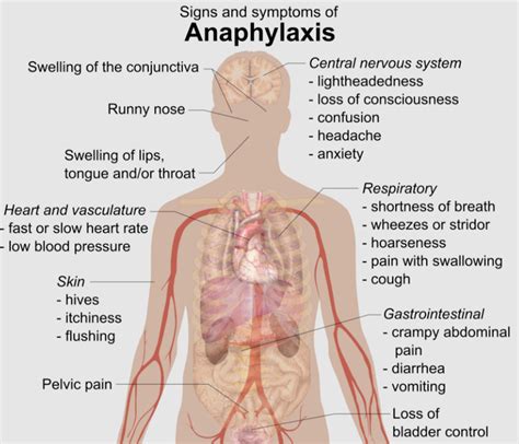 Anaphylaxis Management: More than Just an Epi-Pen!