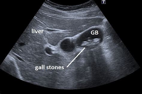 All You Ever Wanted to Know about Gallstones - Penang Surgeon