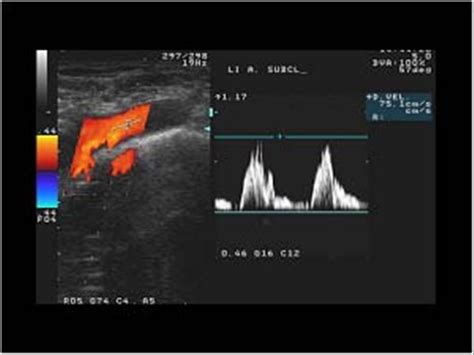 Peripheral vessels | 10.1 Peripheral arteries : Case 10.1.2 Vertebral artery and subclavian ...