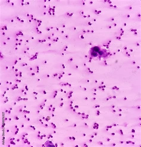 Thyroid nodule (FNA cytology): Cellular follicular lesion, microscopic show cellular material of ...