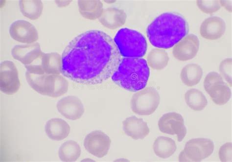 317 Leukemia Blast Cell Stock Photos - Free & Royalty-Free Stock Photos ...