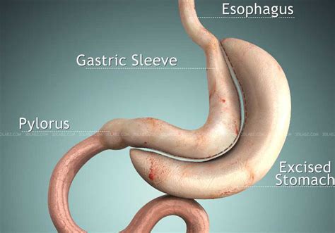 Vertical Sleeve Gastrectomy 3D Illustration