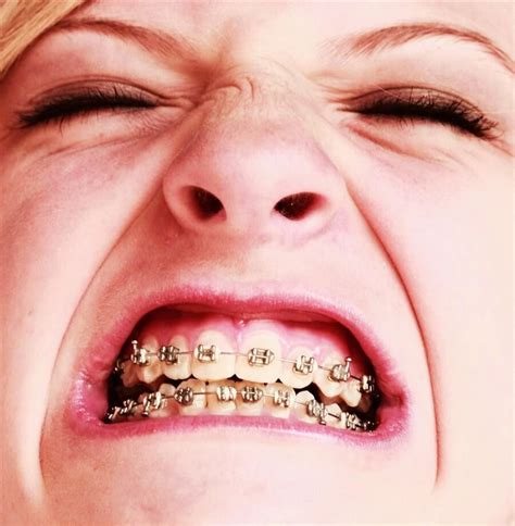 Dentistry Procedures for Good Health and a Better Smile | Fake braces, Brace face, How to make ...