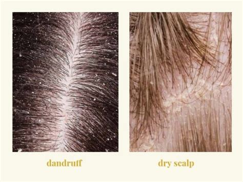 Dandruff vs. Dry Scalp: Causes, Symptoms, and Best Treatments