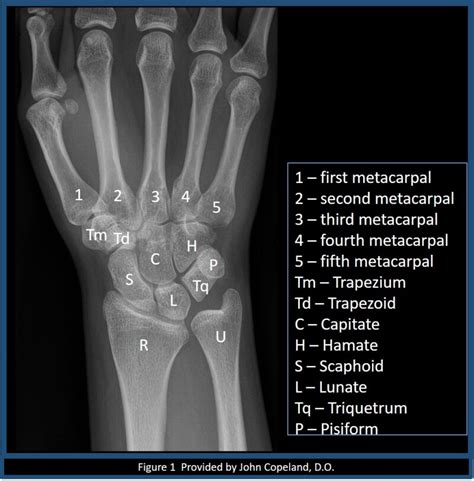 [Figure, Wrist x-ray with labeled osseous anatomy. Contributed by John ...