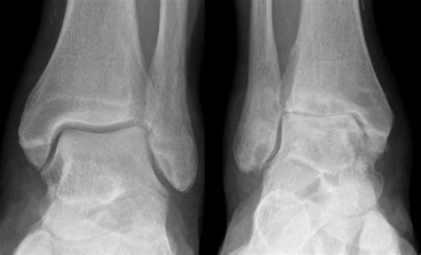 Ankle Arthritis — Ankle Arthritis | Ankle Replacement | Arthrodesis | Ankle Fusion