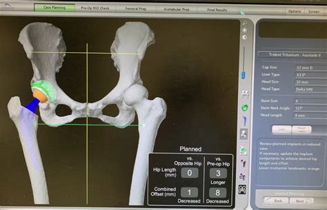 Robot-Assisted Mako Total Hip Replacement