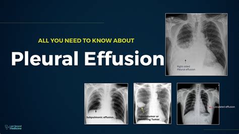 Pleural Effusion - Types, Causes, Evaluation & Management (All You Need ...