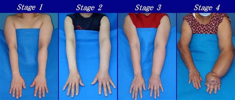 Signs & Symptoms of Lymphedema - Pain & Swelling Solutions