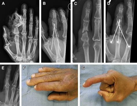 Treatment of Nonunion and Malunion Following Hand Fractures | Plastic Surgery Key