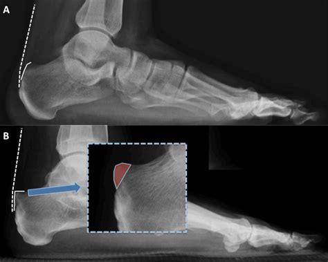 Billing and Coding Haglunds deformity or Retrocalcaneal exostectomy Surgery - Podiatry Coding