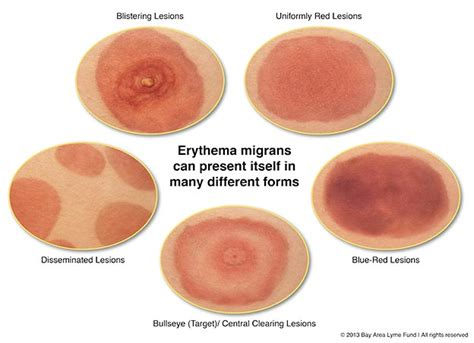 Does Everyone Get the Telltale Bullseye Rash? | Bay Area Lyme Foundation