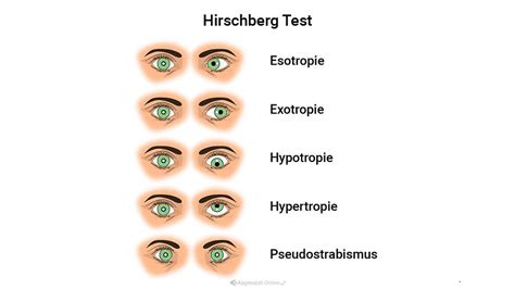 Hirschberg -Test | Lexikon der Augenheilkunde