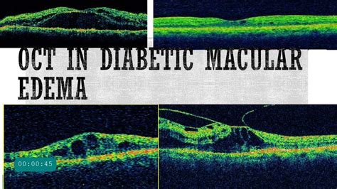 OCT in diabetic Retinopathy || OCT patterns of DME || Biomarkers in OCT - YouTube