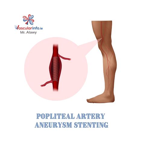 Popliteal Artery Aneurysm - Vascular Info