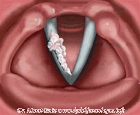 Larynx Cancer - Definition, Causes, Risk Factors, Symptoms and Treatment