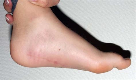 Arteriovenous Malformation: An Unusual Reason for Foot Pain in Children | The Foot and Ankle ...