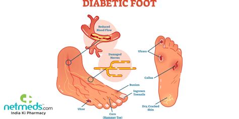 Diabetic Foot Infection: Causes, Symptoms and Treatment