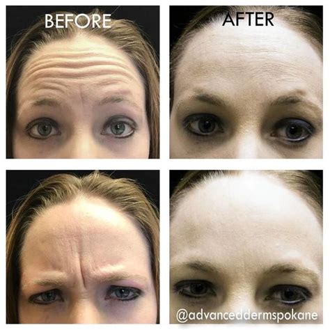 Botox Work On Deep Forehead Wrinkles » Facial Injections: Info, Prices ...