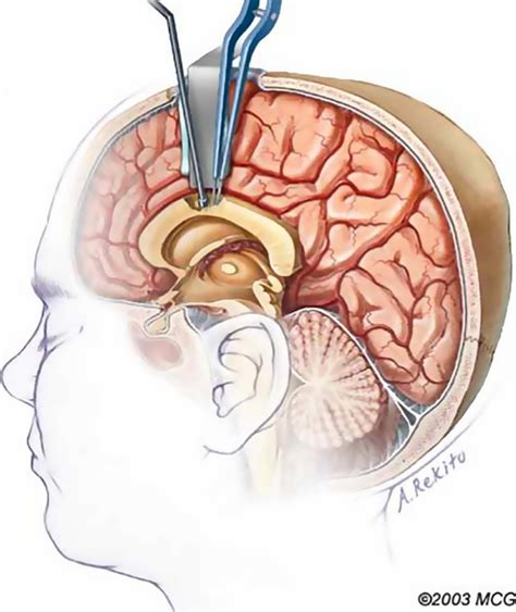 Surgical options for patients with Lennox‐Gastaut syndrome - Douglass - 2014 - Epilepsia - Wiley ...