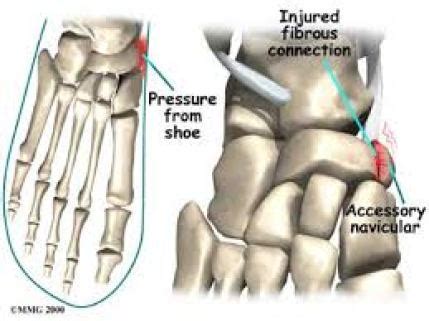 العظم الزورقي الإضافي : Accessory navicular bone | الدكتور مازن كردية