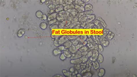 Fat globules in Stool Microscopy - YouTube