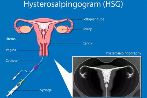 Hysterosalpingography - When And Why is it Done? - Being The Parent