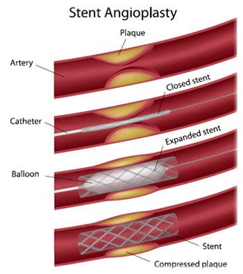 Artery Treatments