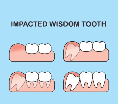 Wisdom Teeth Extractions - Dallas Dental - Dallas, GA