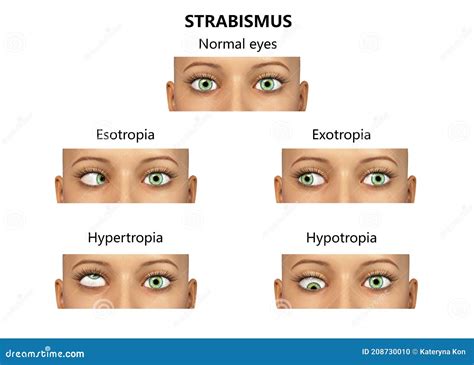 Types OfÂ strabismus. Esotrobia And Exotrobia Cartoon Vector ...