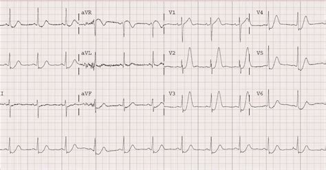 Dr. Smith's ECG Blog: Hyperacute T waves