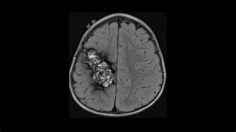 Cavernoma - Neuro MR Case Studies - CTisus CT Scanning