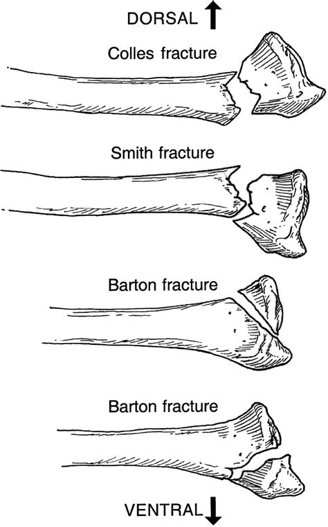 Common Distal Radius Fractures (fprmed.com)