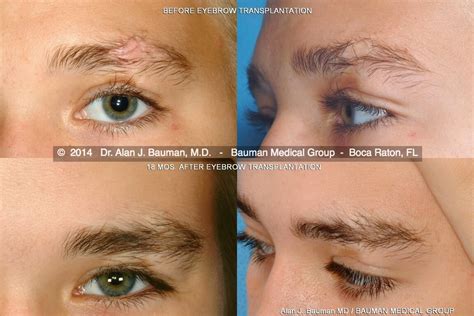 Eyebrow Transplantation | Special Cases | Bauman Medical Group