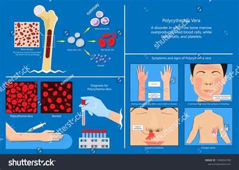 Polycythemia Vera Pv Blood Clots Cancer Stock Vector (Royalty Free) 1390054730 | Shutterstock