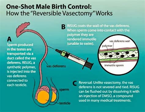 Male contraceptives are coming, but will you use them?