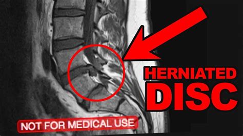 L4-L5 Micro Discectomy - 1 Year after my Herniated Disc Surgery - YouTube