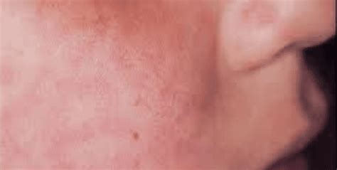 HIV Skin Rash - Images, Causes, Symptoms, Treatment - HubPages