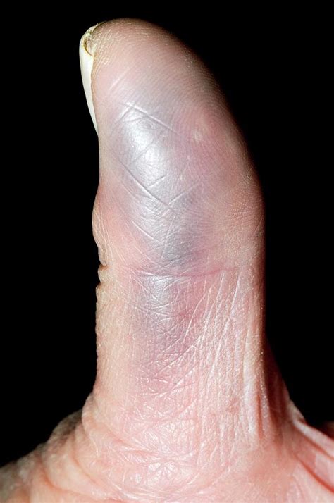 Bruise On The Finger Photograph by Dr P. Marazzi/science Photo Library