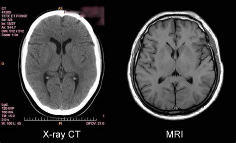 Inventor of the MRI denied the 2003 Nobel Prize in Medicine