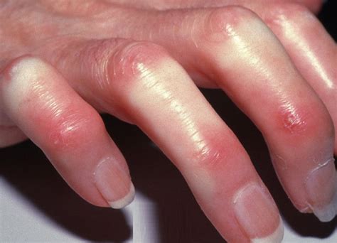 Scleroderma - Symptoms, Pictures, Causes, Treatment, Complications | HealthMD