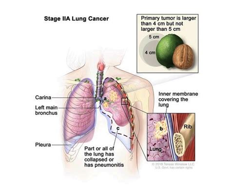 Lung cancer: MedlinePlus Genetics