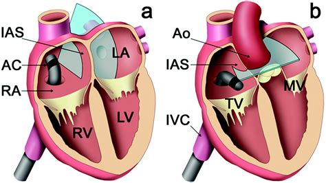 Intracardiac Echocardiography Is Superior to Conventional Monitoring for Guiding Device Closure ...