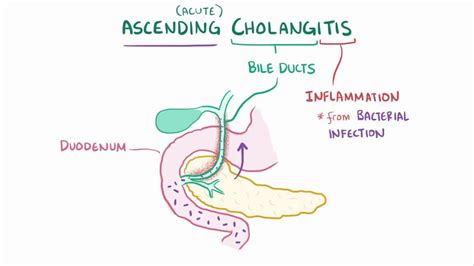 Ascending cholangitis: Video, Anatomy & Definition | Osmosis