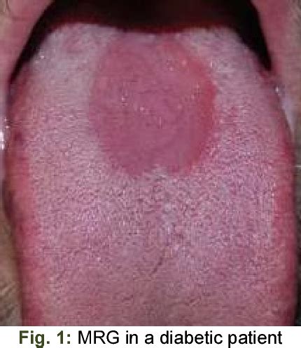 Figure 1 from The Prevalence of Median Rhomboid Glossitis in Diabetic Patients: A Case-Control ...